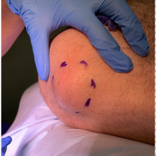 Lipoma on the shoulder