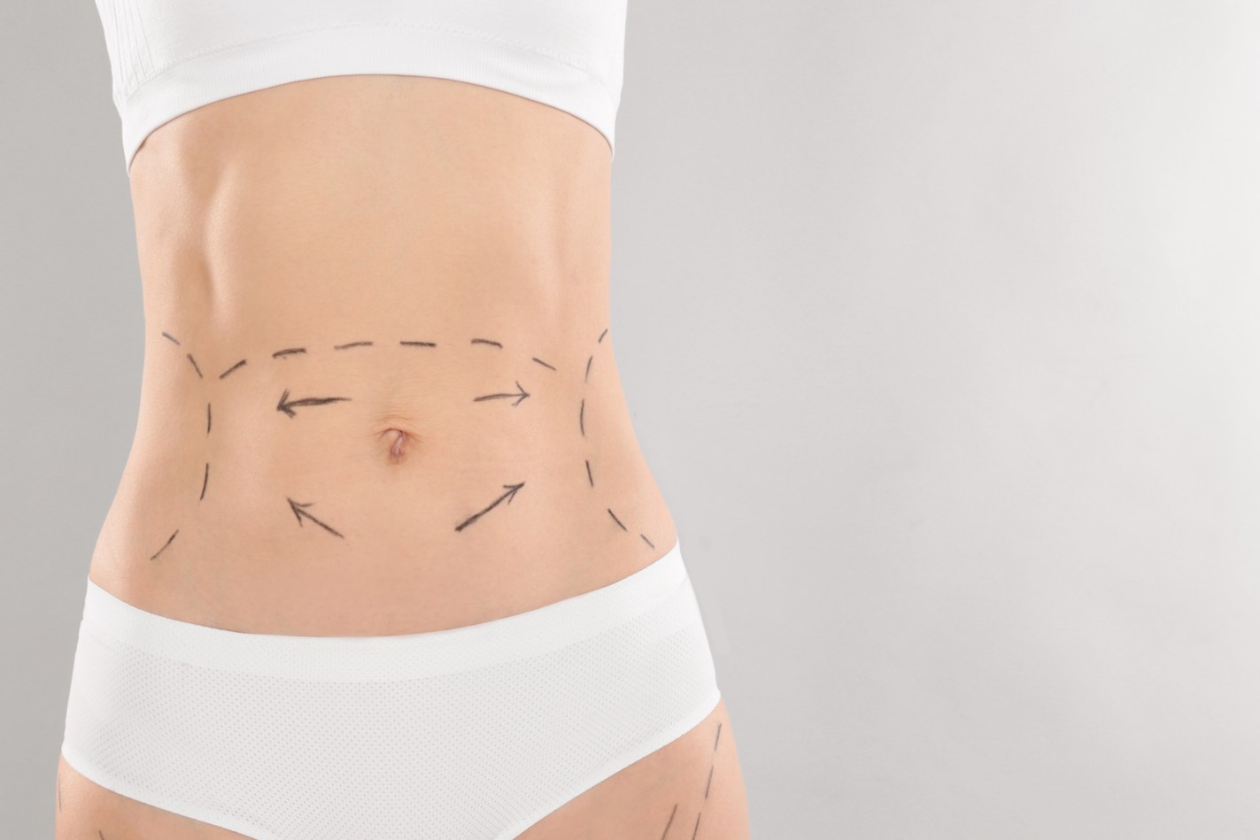 Liposuction