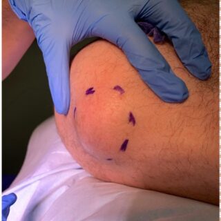 lumps-and-bumps-mole