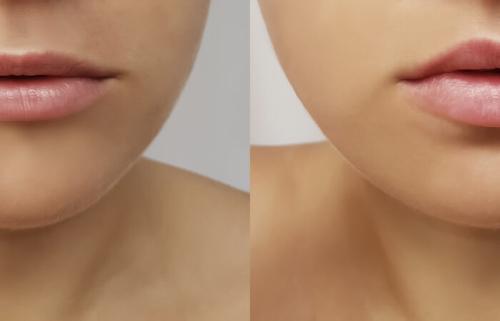 Girl's lips before and after fillers