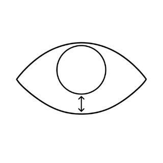 Ectropion