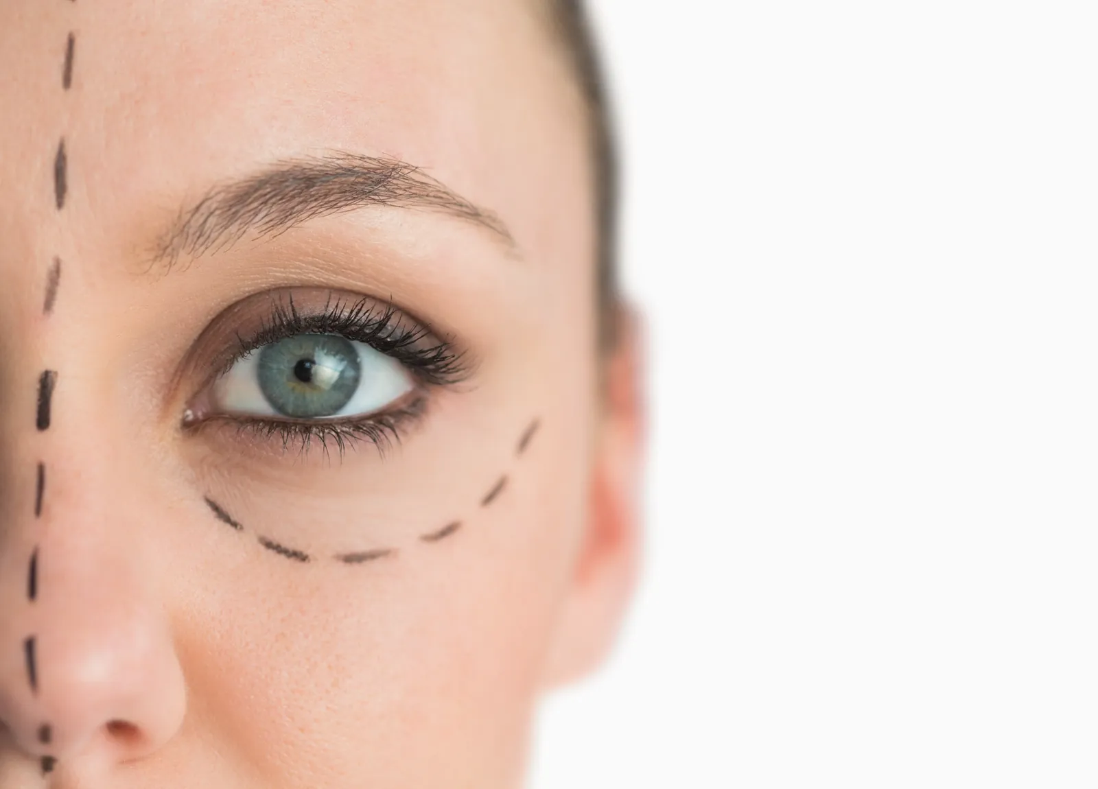 Lower Eyelid Blepharoplasty,